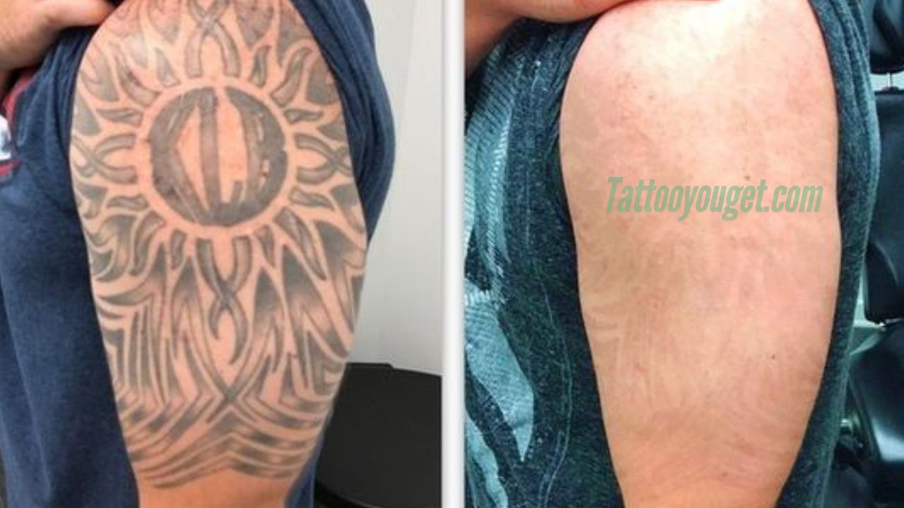 Tattoo Removal Before and After: A Complete Guide to Effective Results